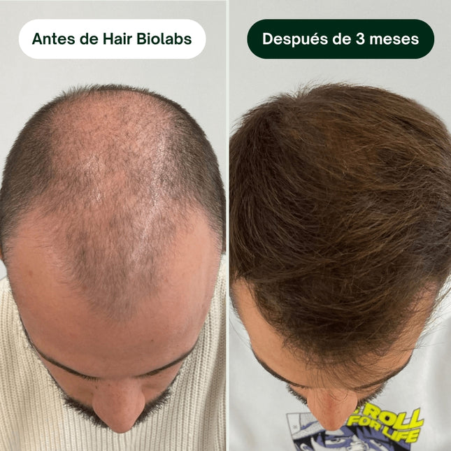 SUPER COMBO: Serum Anticaida Capilar + Shampoo Fortalecedor de Foliculos