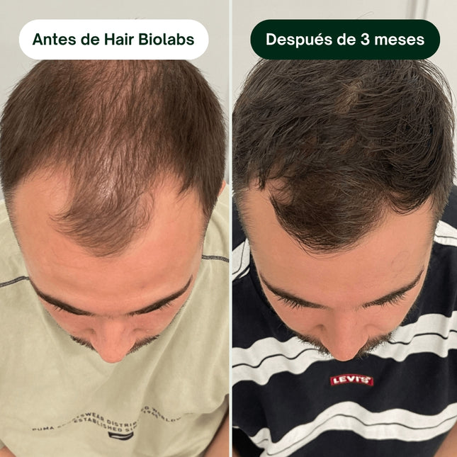 SUPER COMBO: Serum Anticaida Capilar + Shampoo Fortalecedor de Foliculos