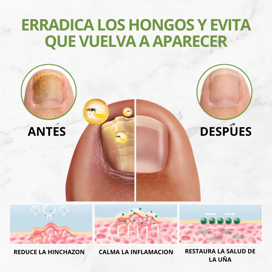 (SUPER OFERTA 2X1) - Aceite de veneno de abeja para eliminar hongos en las uñas