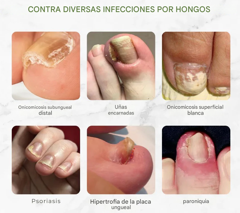 (SUPER OFERTA 2X1) - Aceite de veneno de abeja para eliminar hongos en las uñas